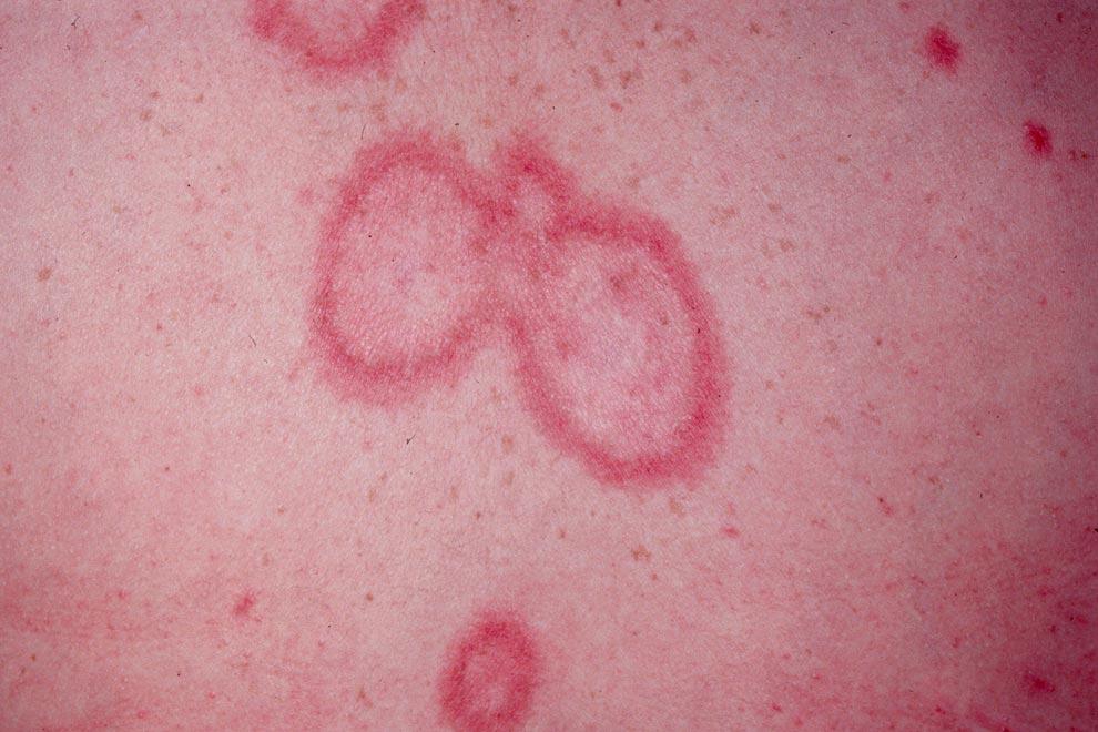 Lupus eritematoso