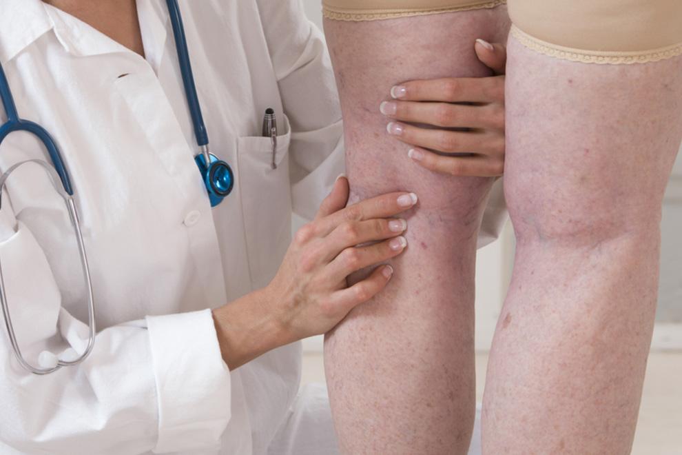 Remediar el edema en las piernas