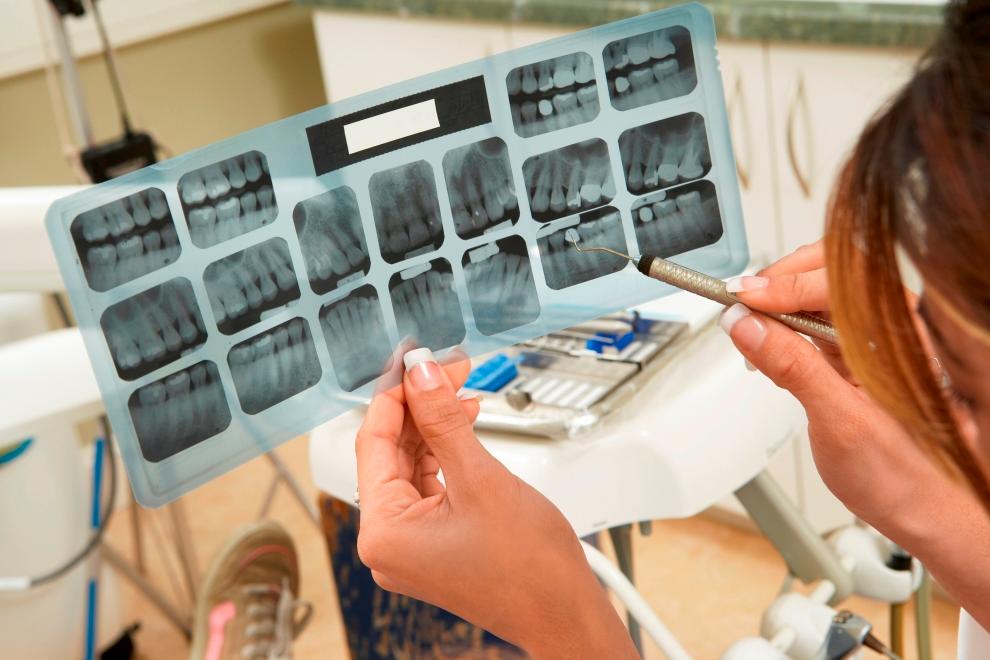 amalgamas dentales en odontologia