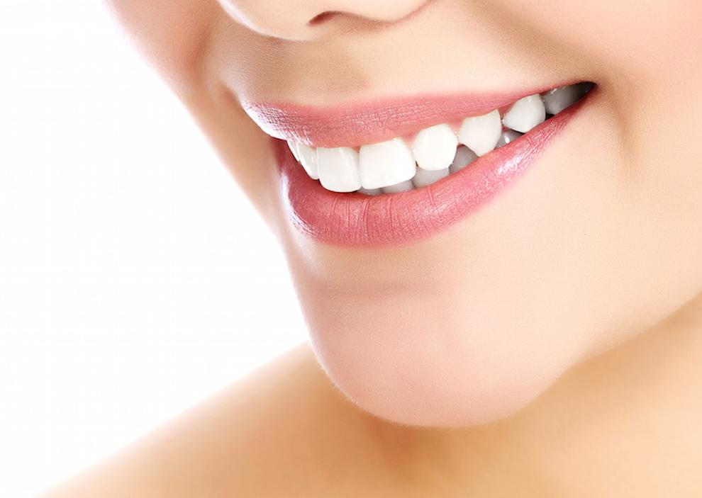blanqueamiento dental cómo se hace, blanqueamiento dental procedimiento