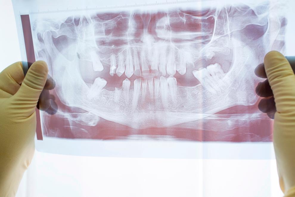 diente negro, diente oscuro, necrosis pulpar