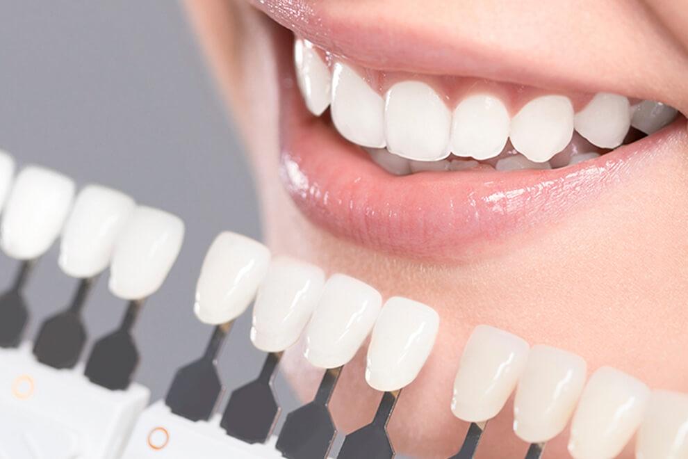 Consigue la sonrisa con la que sueñas con las carillas dentales - Clínica  Dental Valvanera