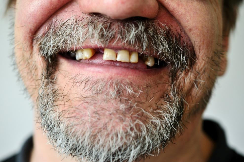 pérdida de dientes, perder los dientes