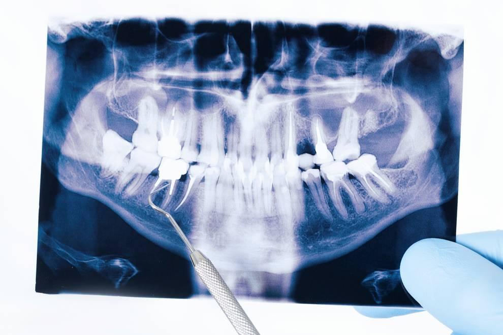 prognatismo mandibular
