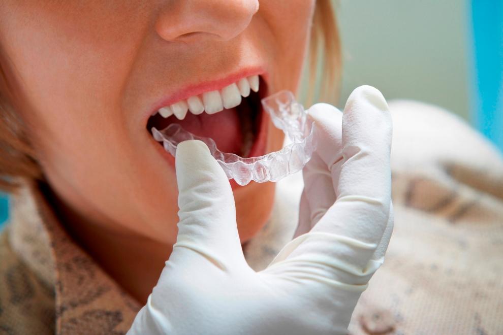 retenedores en ortodoncia