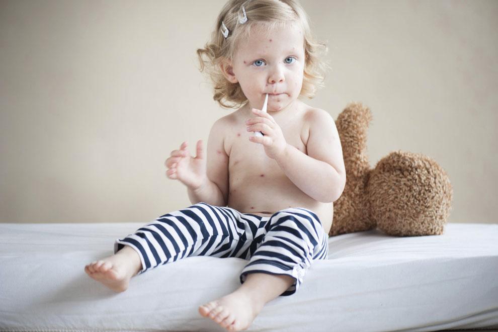 Rubeola infección virus