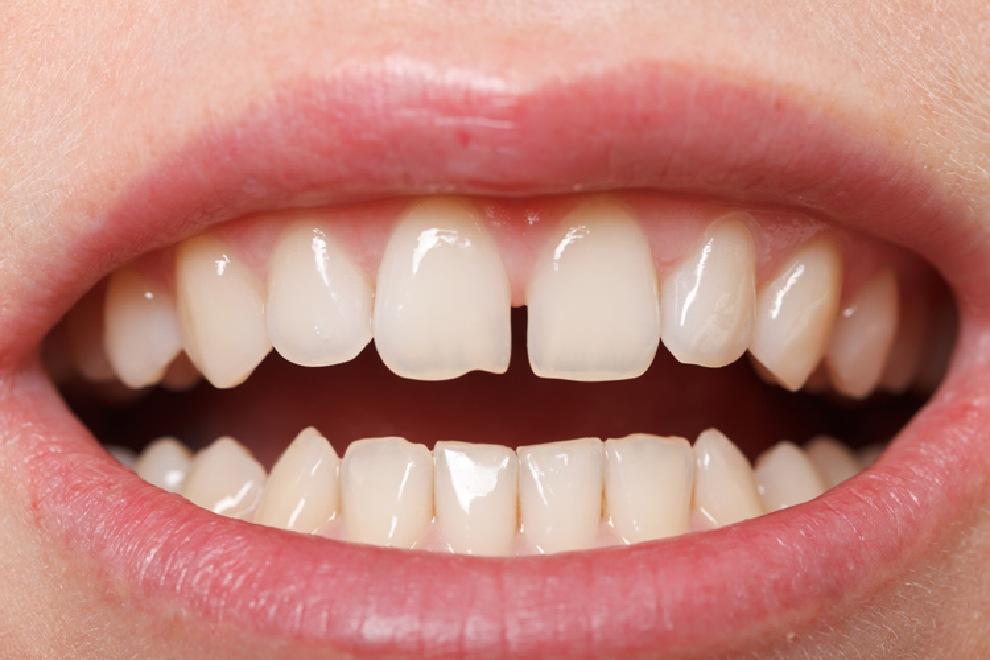 cuidado dientes leche