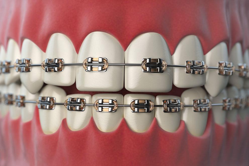 ¿Cómo se usa la cera para brackets?