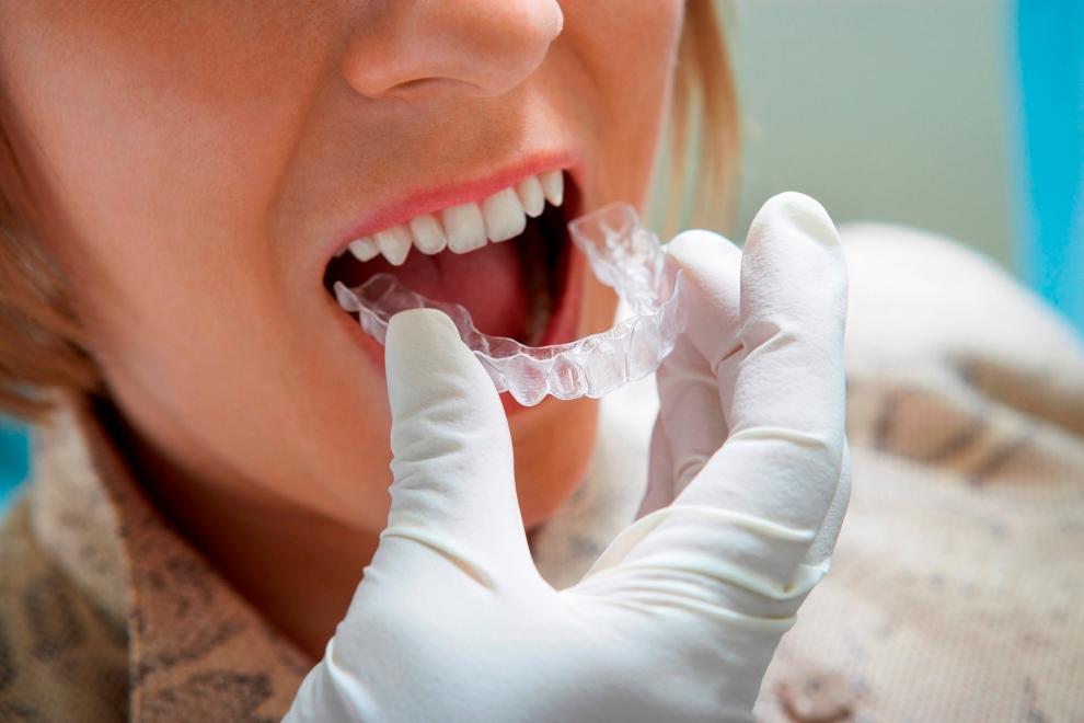 Consejos para elegir la férula dental