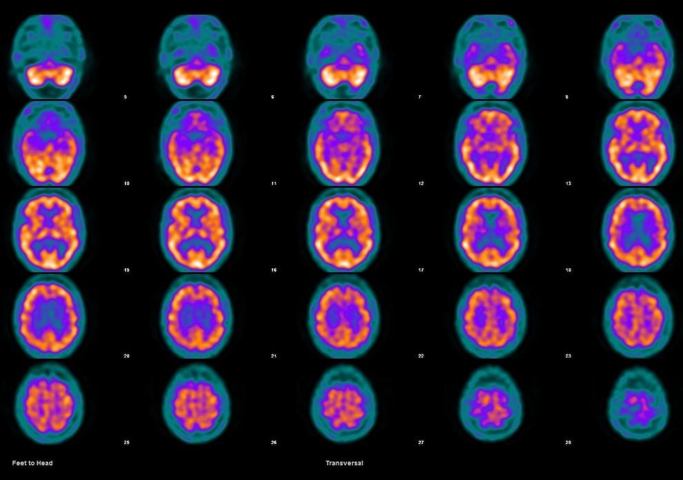 Qué es un SPECT cerebral