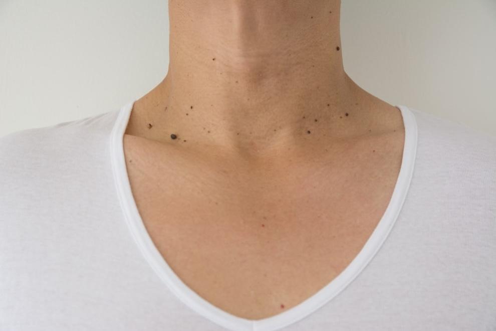 Quitar verrugas cuello