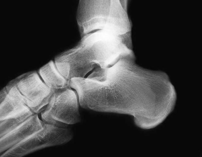 Imagen lesiones lesOsea calcaneo talon