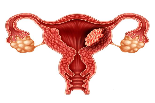 cáncer de útero