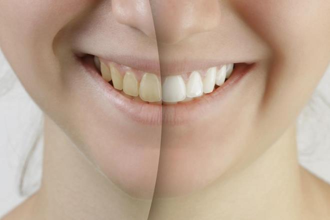 blanqueamiento dental por fotoactivación