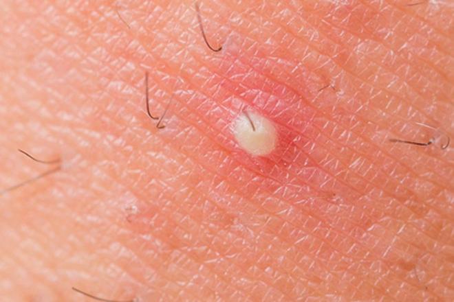 Bulto en la axila. Forúnculo o golondrino