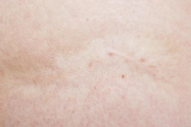 Cirugía estética. Cómo corregir cicatrices