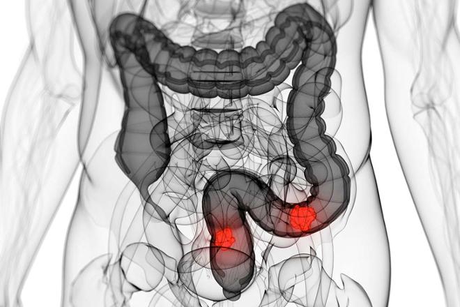Diarrea crónica y cáncer