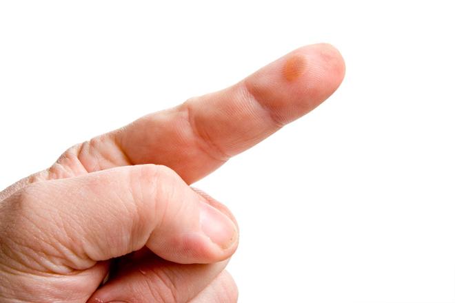 ampollas acumulación líquido