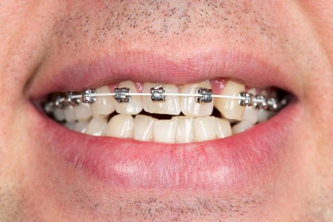 ortodoncia en adultos