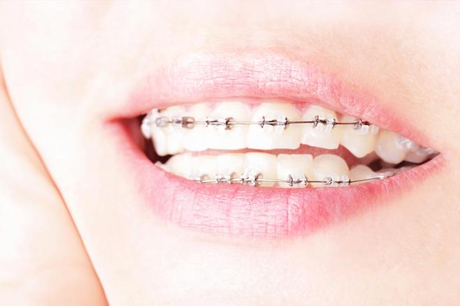 ortodoncia infantil aparatos fijos