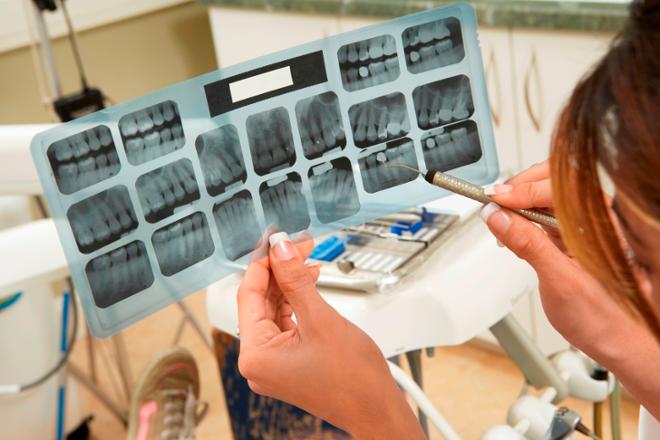 amalgamas dentales en odontologia