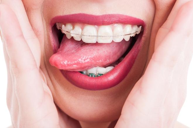 brackets cristal, brackets de cristal