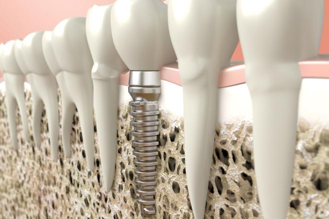 carga inmediata, implantes carga inmediata