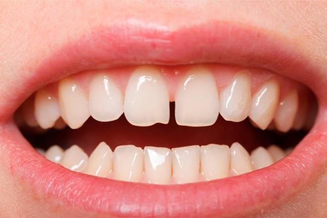diastema dientes separados