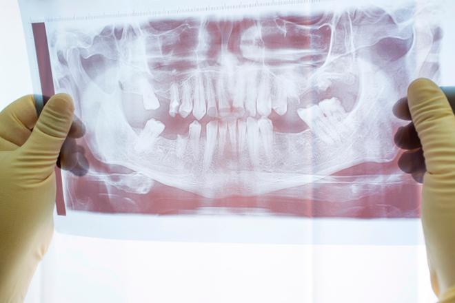 diente negro, diente oscuro, necrosis pulpar