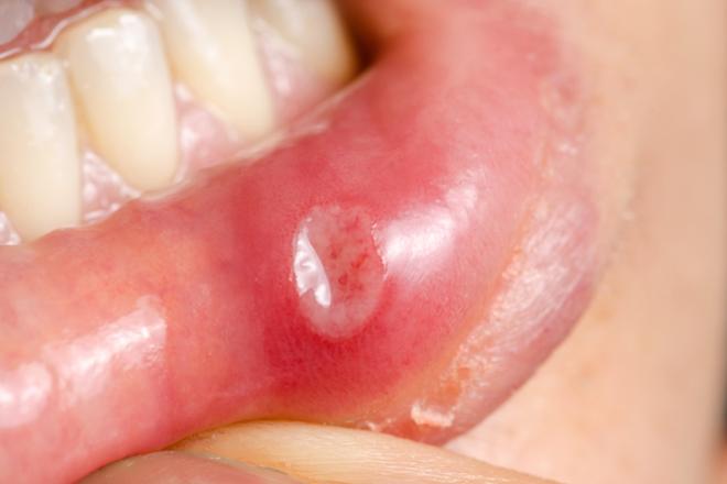 estomatitis aftosa