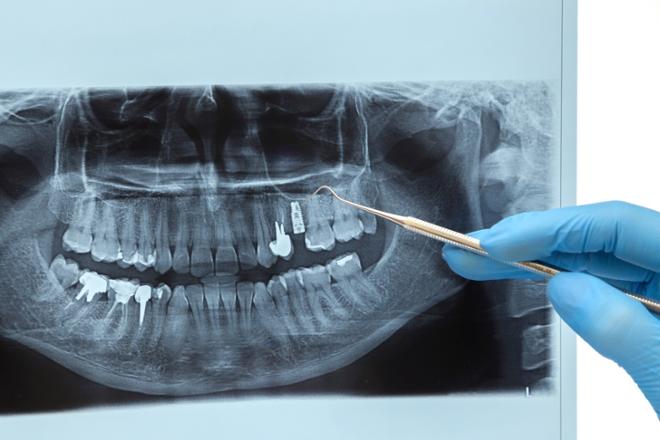 estudio implantológico, estudio para implantes