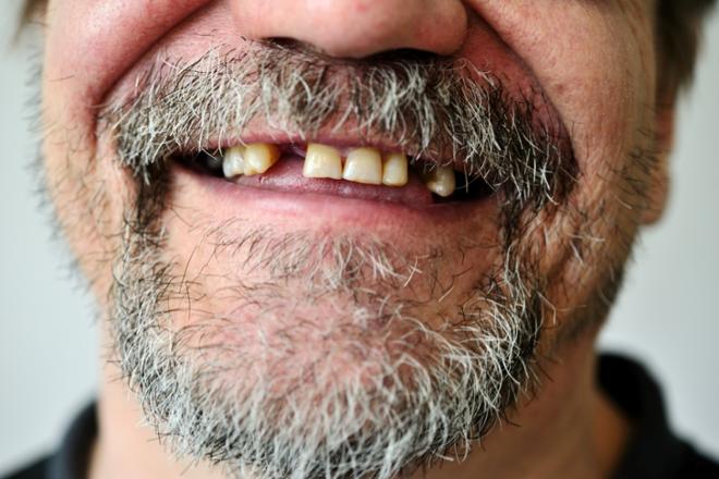 pérdida de dientes, perder los dientes