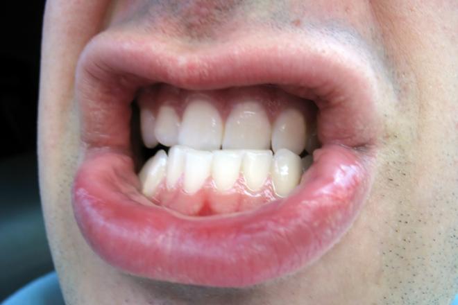 sintomas de la piorrea