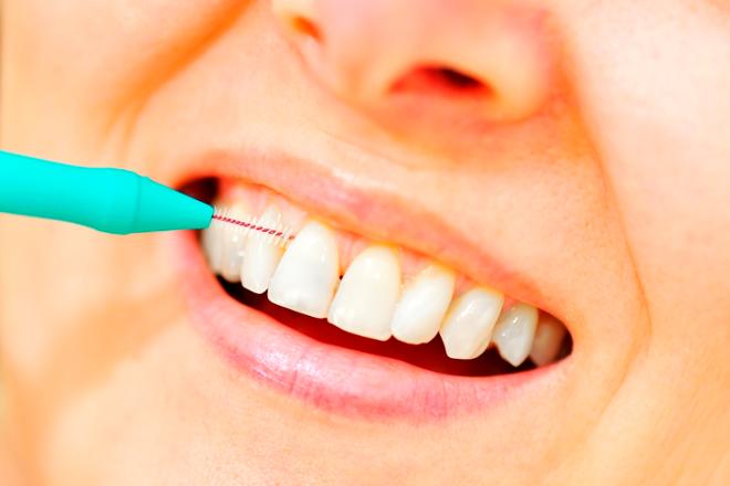 tratamiento de la piorrea