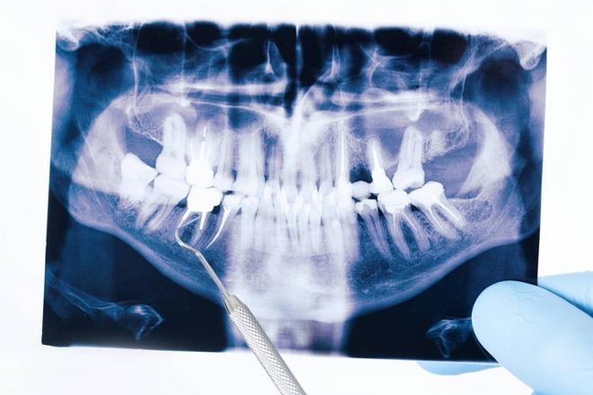 prognatismo mandibular