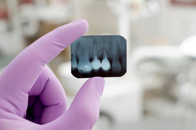 radiografías dentales, radiografías de los dientes