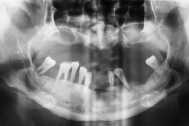 regeneración ósea, regeneración ósea sobre implantes