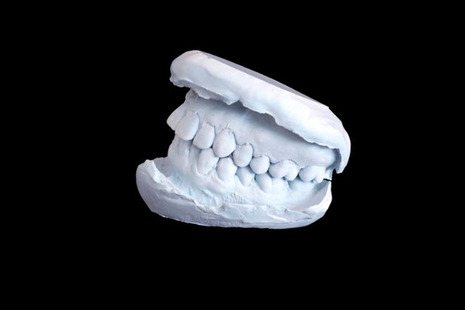 sobremordida problema de oclusión