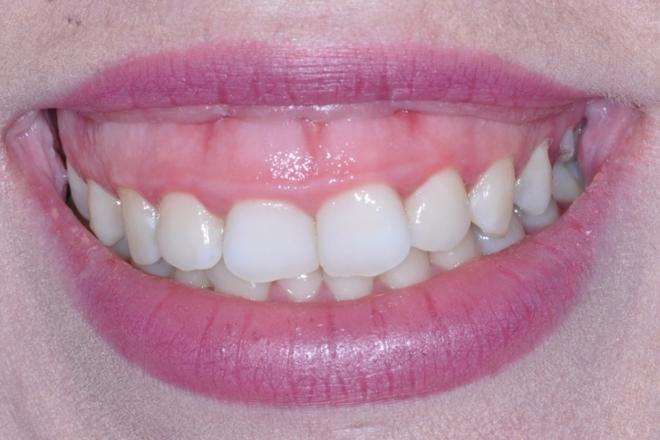 sonrisa gingival