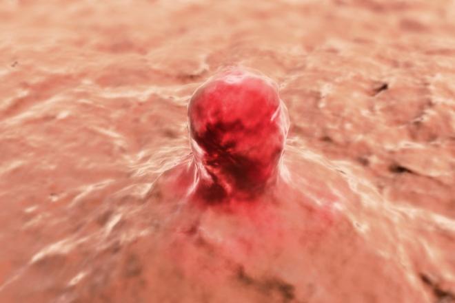 sarcoma de partes blandas