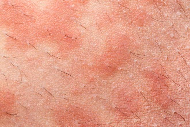 Eczema inflamación de la piel
