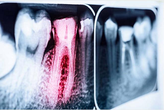 Mal aliento por caries