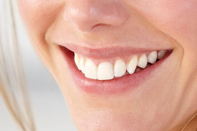 colocación carillas dentales