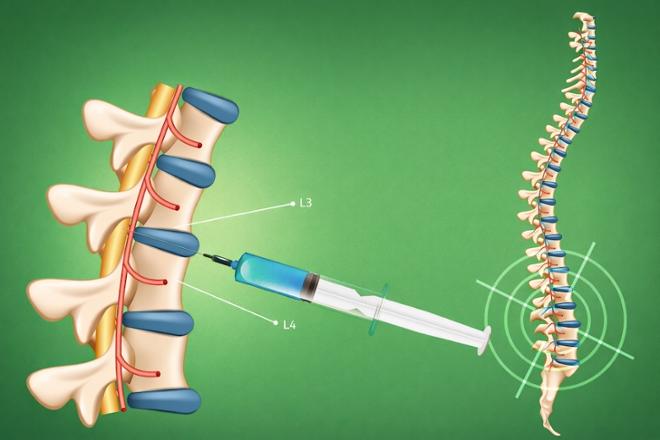 ¿La punción lumbar duele?