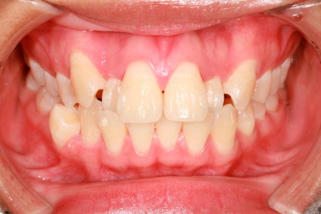 apiñamiento dental