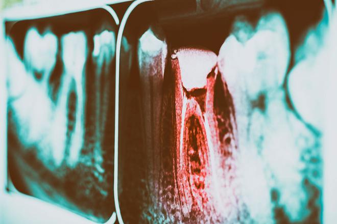 endodoncia multirradicular