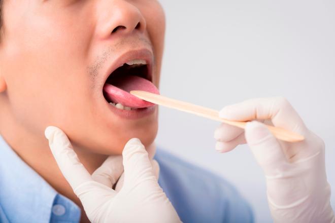 glositis inflamación de la lengua