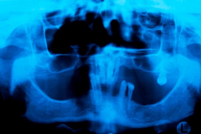 implante zigomático, implante cigomático