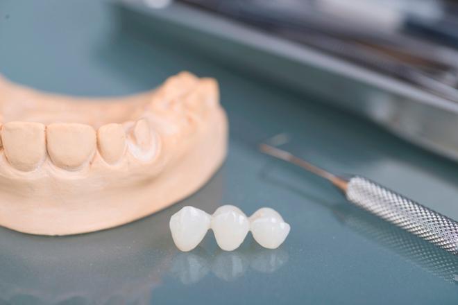 incrustación dental