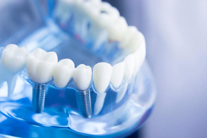 mejor seguro para implantes dentales